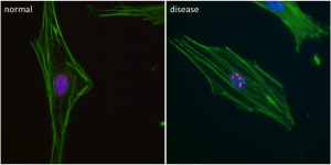 normal vs diseased cell