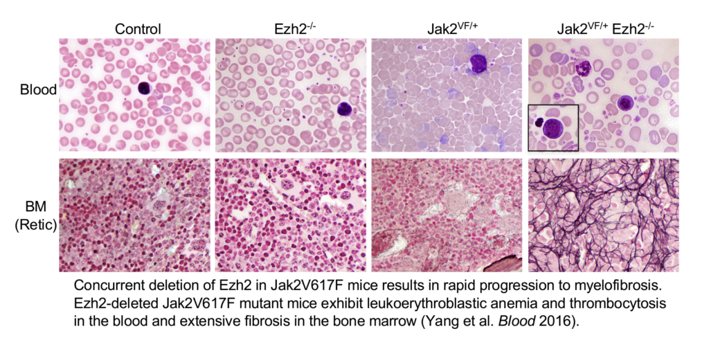 Loss of EZH2 and JAK2v617F mutant in progession of MF