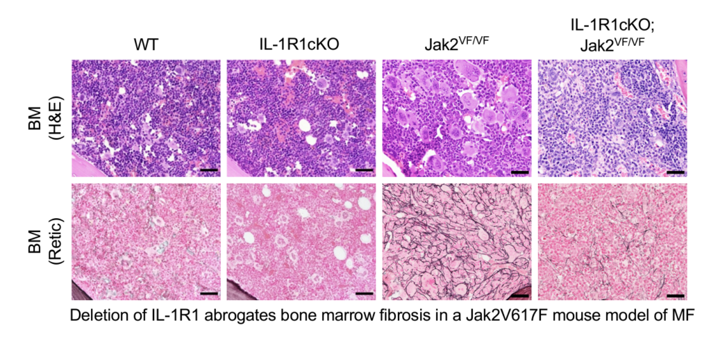Deletion of IL 1r1 abrogates bone marrow fibrosis