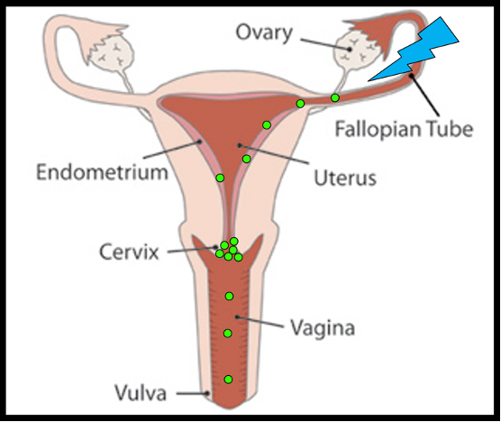 Chlamydia dissemination in the female genital tract