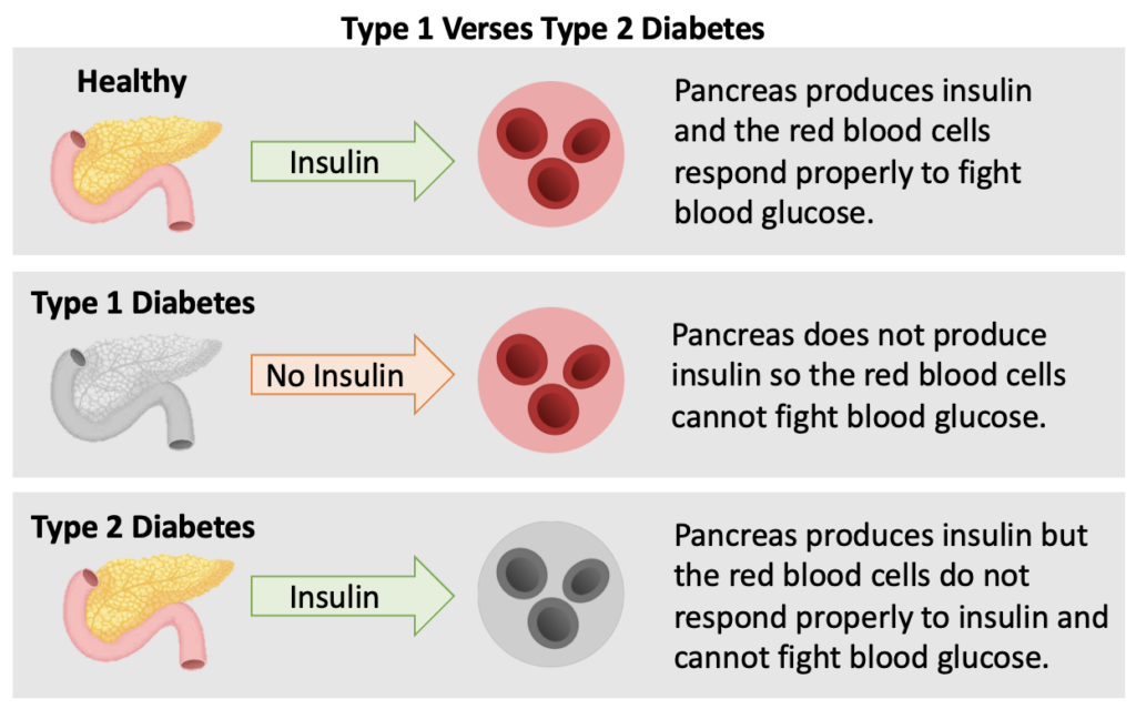 Graphic describing the difference between type 1 and type 2 diabetes. In a healthy pancreas, insulin is produced when a high level of blood glucose is detected. The red blood cells respond properly and accepts the insulin to fight the high level of blood glucose. In a person with Type 1 Diabetes, the pancreas either does not produce insulin at all or not enough to combat the high blood glucose. In a person with Type 2 Diabetes, the pancreas produces some insulin, however the red blood cells do not respond properly and resist the action of insulin.