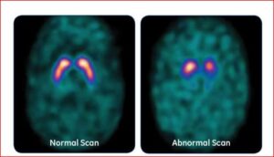 DaT scan of person without Parkinson's disease on left; scan of person with Parkinson's disease on the right