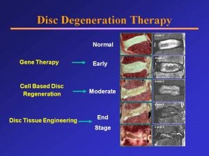 Disc Degeneration Therapy diagram