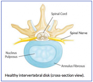 healthy intervertebral disk cross section view spinal cord spinal nerve nucleus pulposus annulus fibrosus