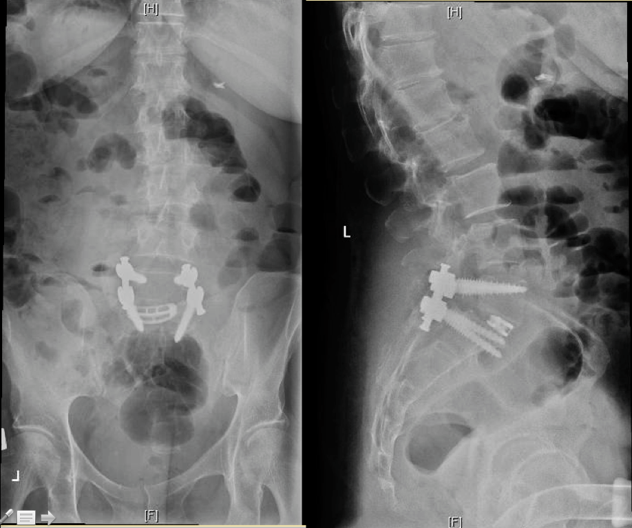 Lumbar fusion for spondylolisthesis Joshua Li, MD