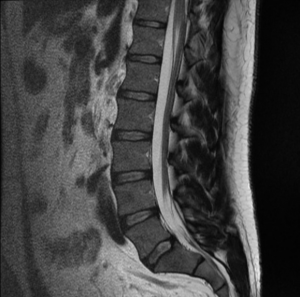 Normal Images of Spine | Joshua Li, MD, PhD