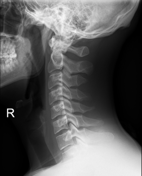 Normal Images of Spine - Joshua Li, MD, PhD
