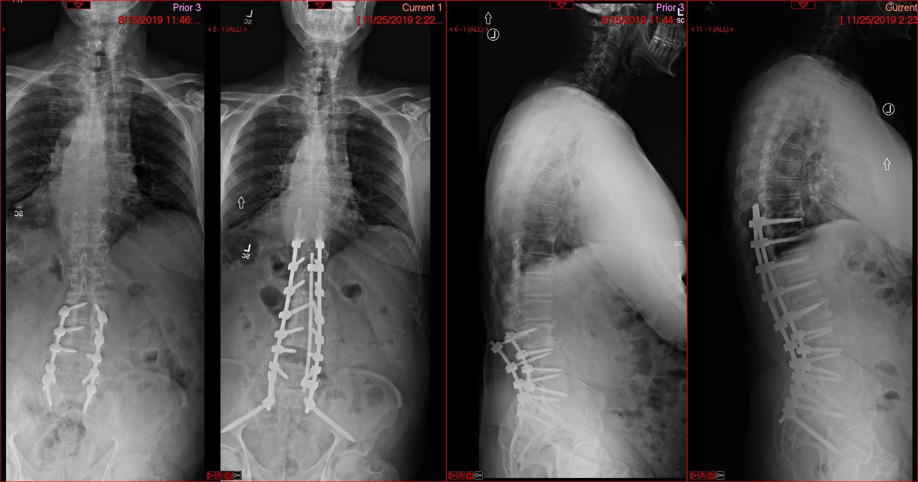 Scoloisis Reconstruction | Joshua Li, MD, PhD