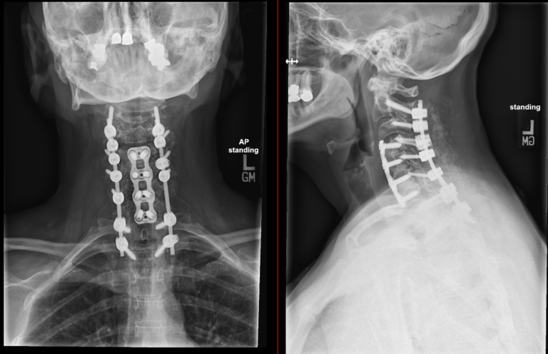 cervical-posterior-fusion-joshua-li-md-phd