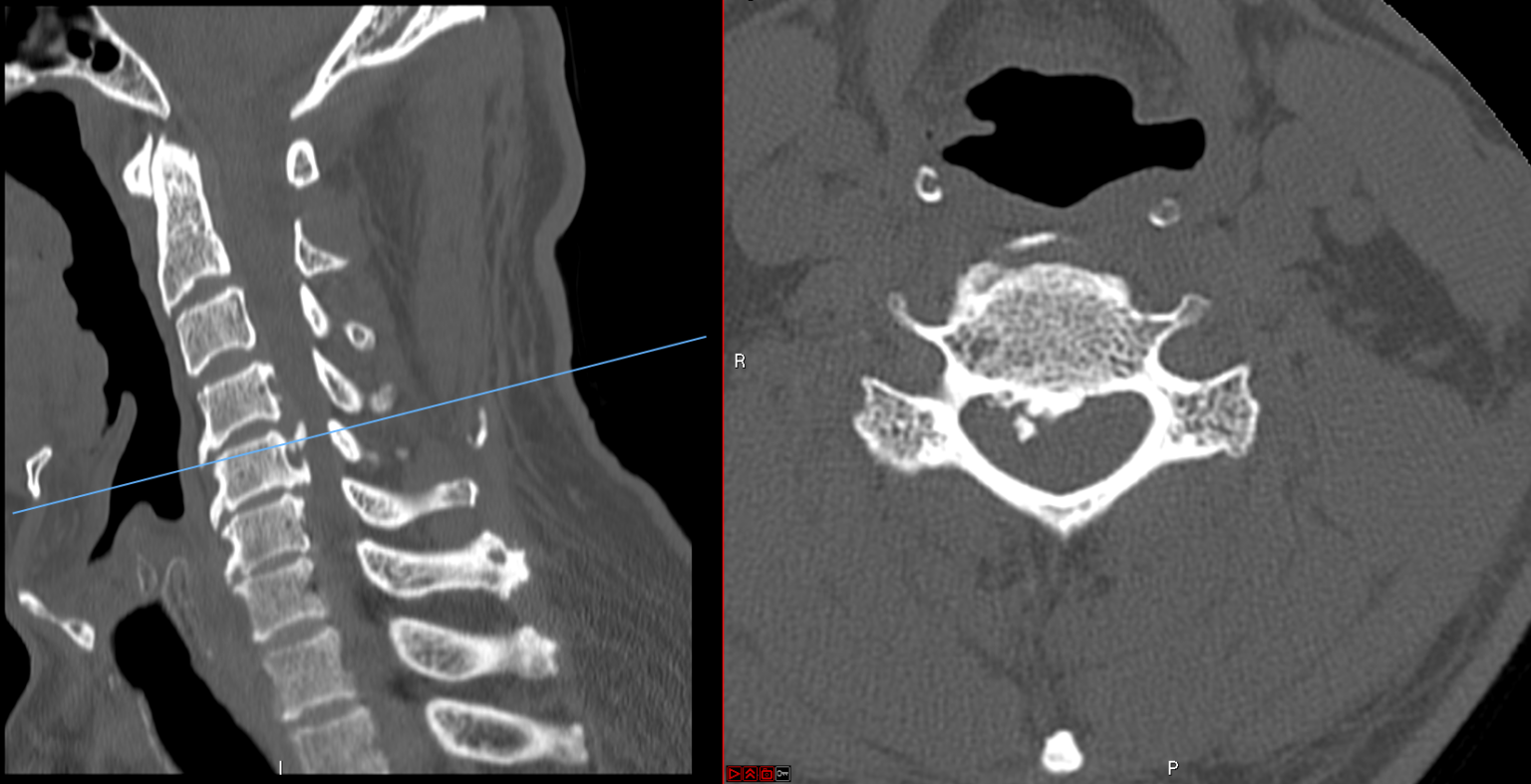 Anterior Cervical Corpectomy And Fusion Accf Joshua Li Md Phd 6576