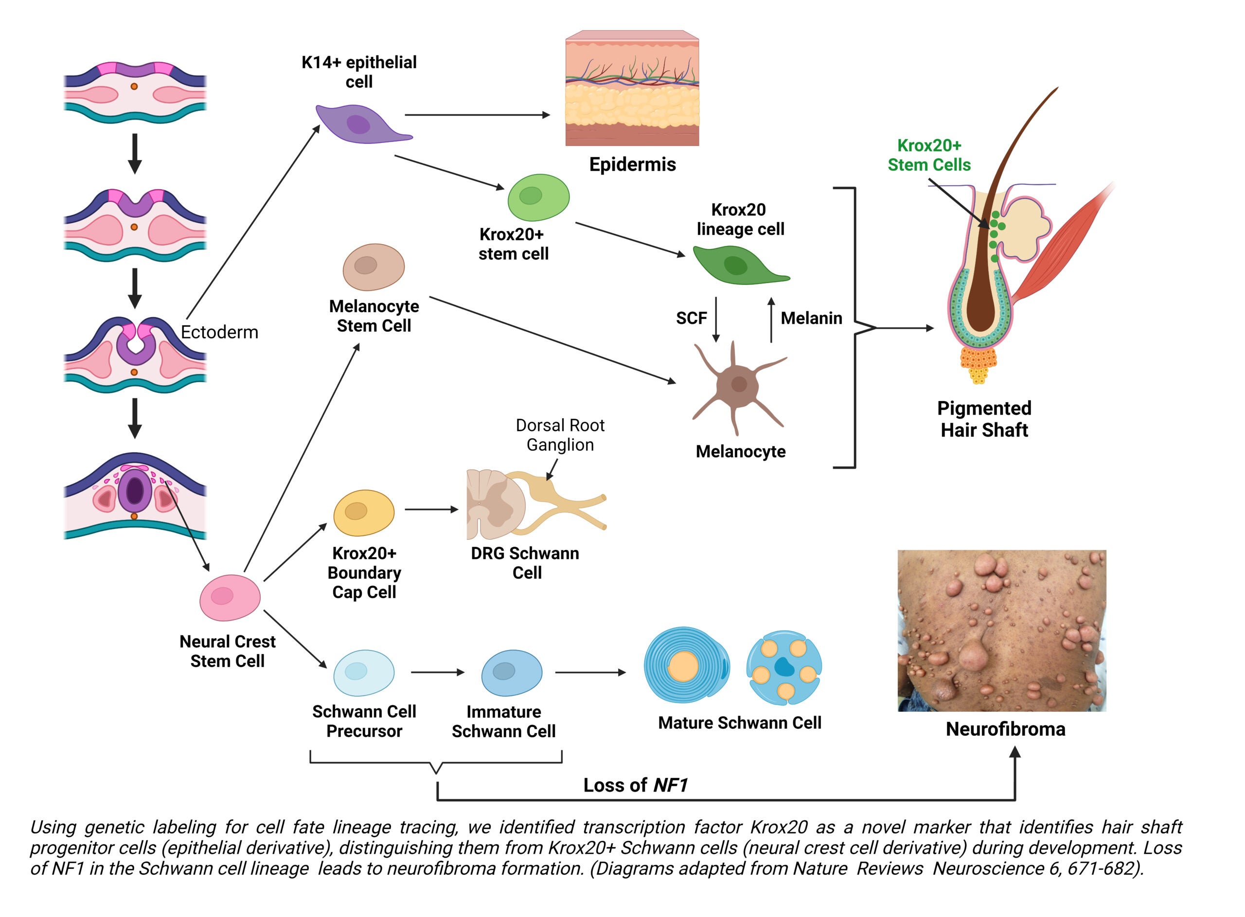 Schematic drawing showing the cell of origin for neurofibroma 