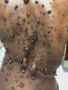 Cutaneous neurofibroma covering the back of an NF1 patient