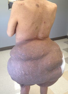 plexiform neurofibroma on an individual with NF1