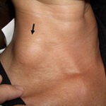 A schwannoma growing on the neck of a schwannomatosis patient