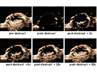 reperfusion in colon adenocarcinoma monitored by ultrasound
