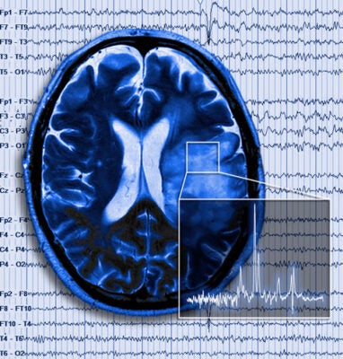 Brain Tumor with Seizure - Sontheimer Lab