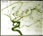 Arteriovenous_image1