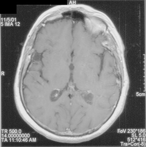 Hemangioblastoma-Fig27b