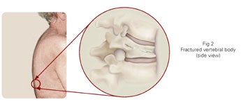 National Osteoporosis Foundation supports new evidence-based vertebral  compression fracture care pathway