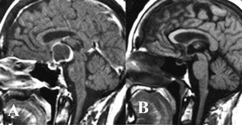 Craniopharyngiomas-fig13