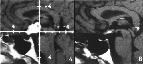 Craniopharyngiomas-fig15