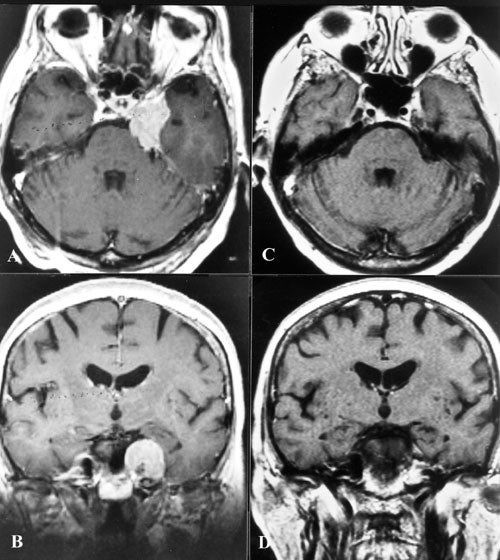 Meningiomas-fig16