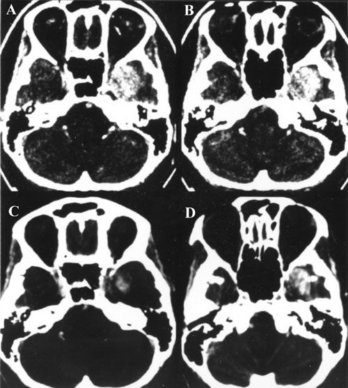 Meningiomas-fig17