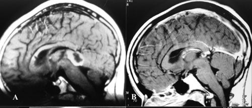 astrocytoma grade 1 life expectancy