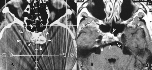 Chordomas-fig22