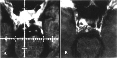 Chordomas-fig23