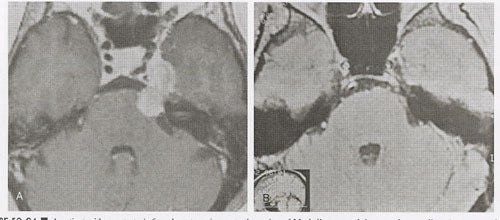 Metastatic-tumors-fig24