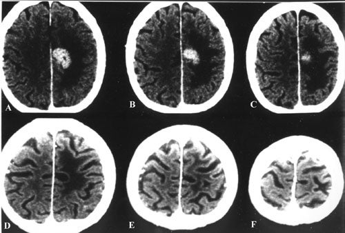 Metastatic-tumors-fig25