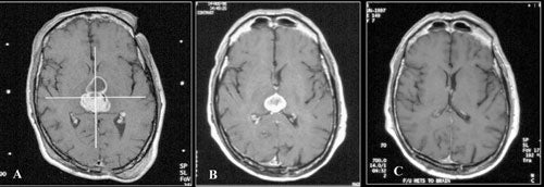 Metastatic-tumors-fig26