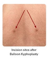 incision