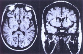 Axial (left) and coronal (right) MRI's illustrating the imaging appearance of bilateral capsulotomies (arrows) seven years after surgery