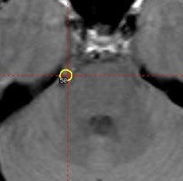 Gamma Knife surgery targeting of the trigeminal nerve for neuralgia