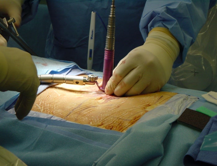Minimally invasive spine surgery | Neurosurgery