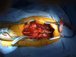 open spine surgery