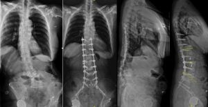 scoliosis image