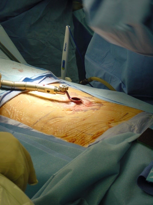 Minimally invasive spine surgery - Neurosurgery