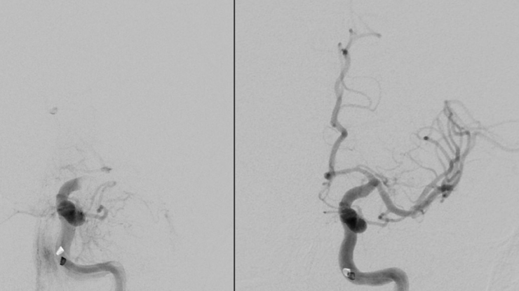 ischemic