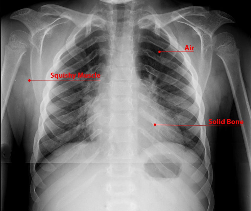 What is an X-ray? (For Kids) - Radiology and Medical Imaging