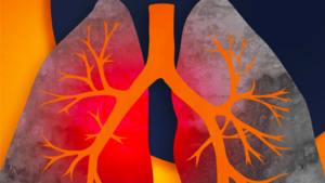 LUNG RESEARCH SUGGESTS NEW WAY TO DETECT, MONITOR LUNG DISEASES